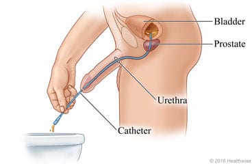 Catheter Diagram - Male